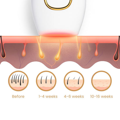جهاز إزالة الشعر بالليزر IPL | تقنية الضوء النبضي المكثف 