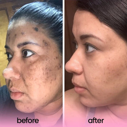 ضمادات الكركم وحمض الكوجيك 